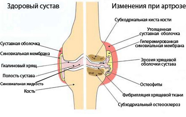 Заговоры артроза коленного сустава